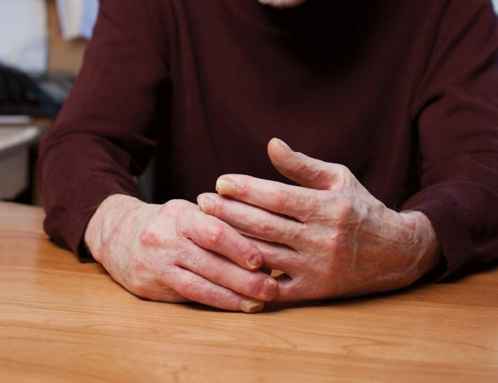 Alan Lokos hands plane crash healing survival wife through the flames miracle